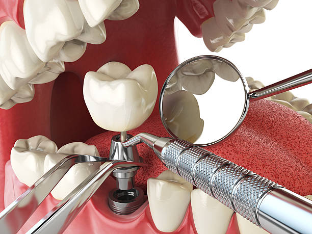 Best Emergency Tooth Extraction in Valenti, NE